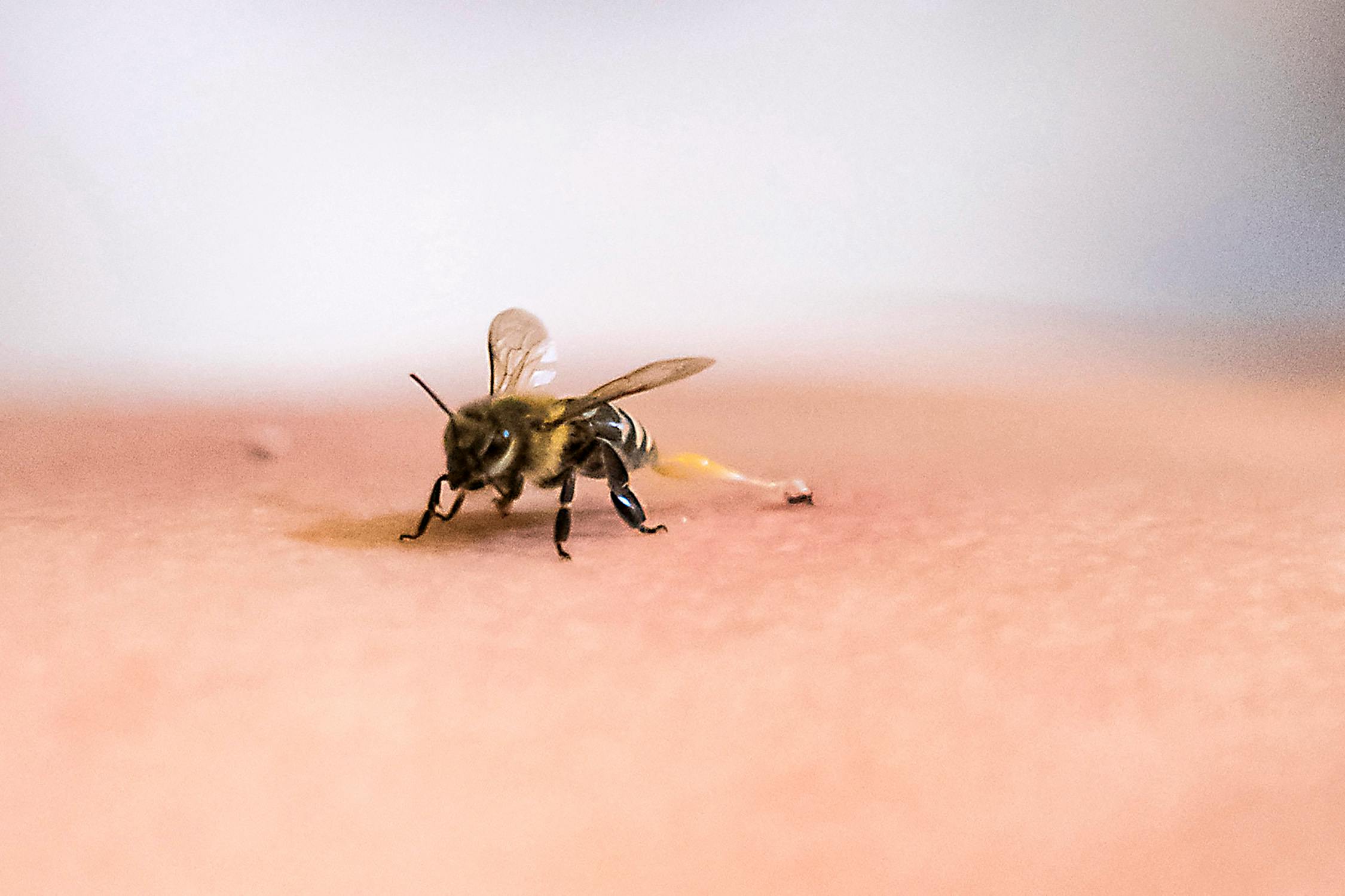 A bee stings the back of a patient receiving treatment